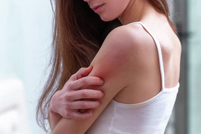 Donna si gratta la parte superiore del braccio arrossata, sintomo visibile di candidosi cutanea