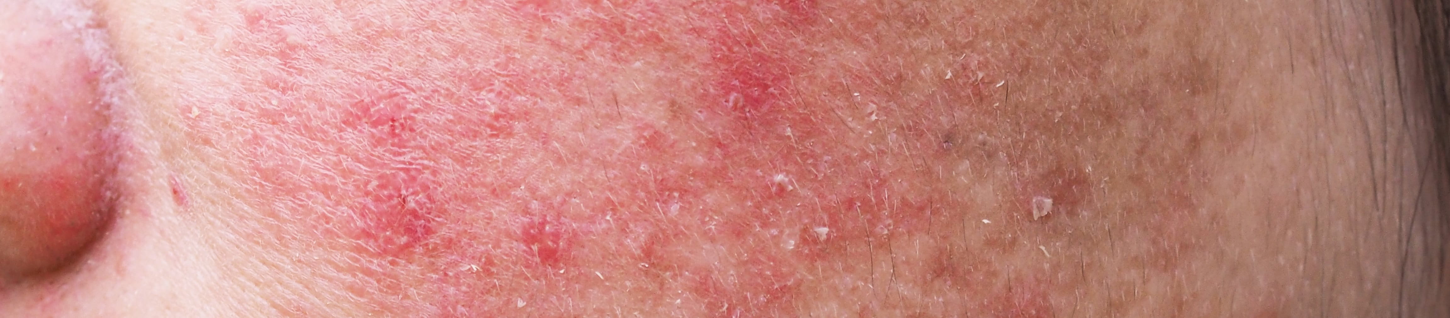 Acne Prone Skin