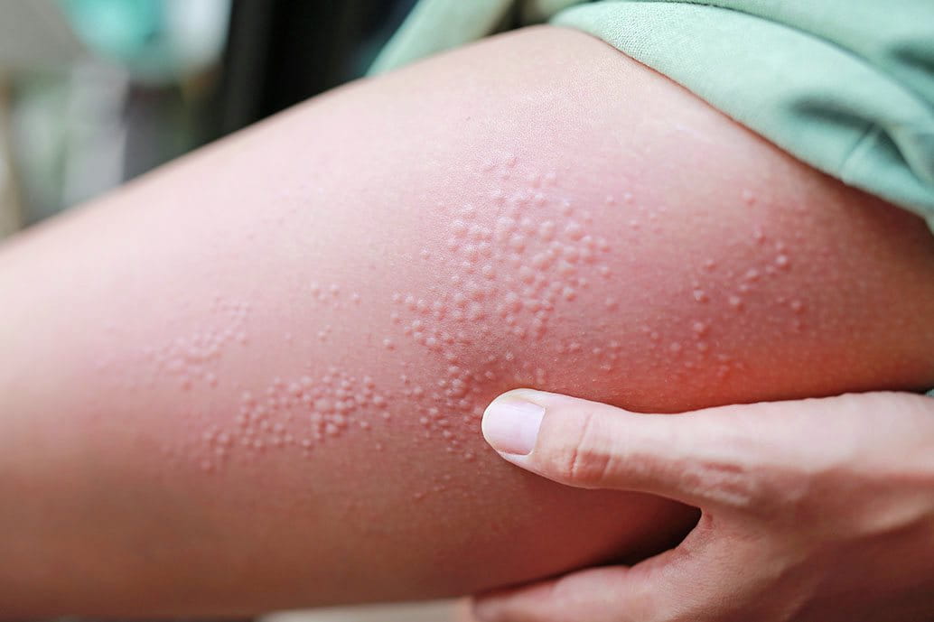 orticaria solare sulle gambe