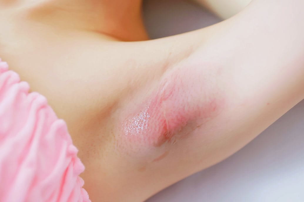 Irritazione cutanea da candidosi sotto l’ascella, con area arrossata e infiammata visibile sulla pelle