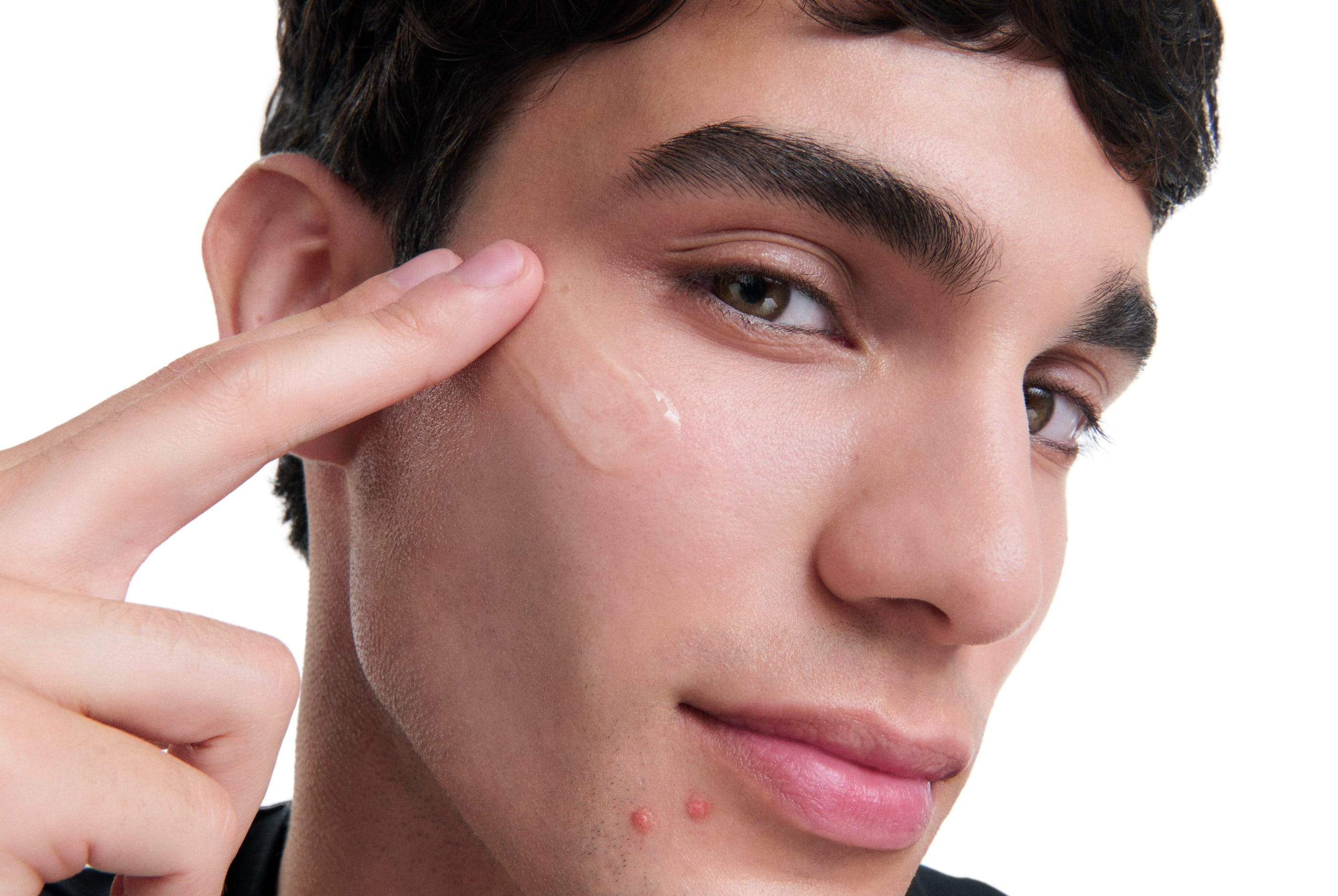 Man applying Eucerin Probiom8 product to blemished, acne-prone skin