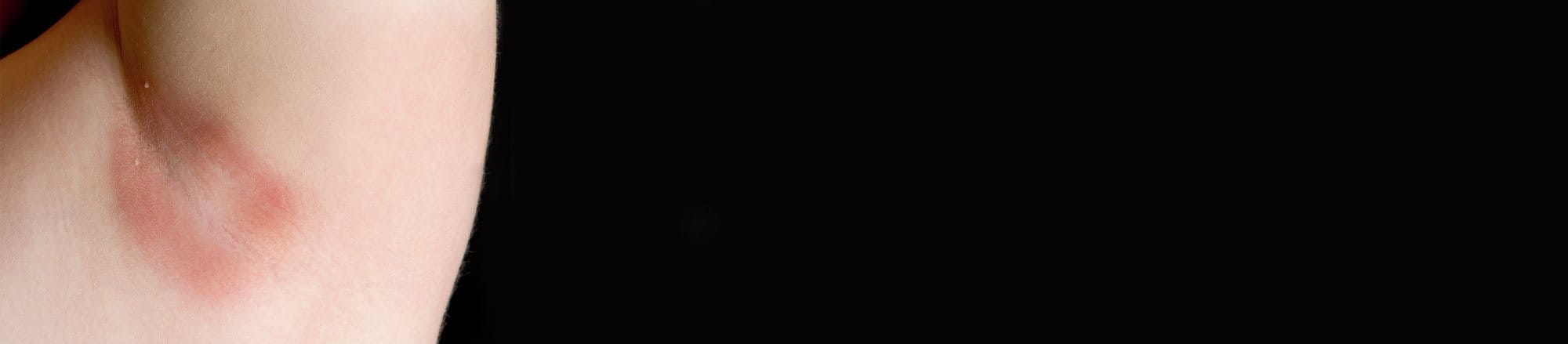 foto donna con intertrigine ascellare