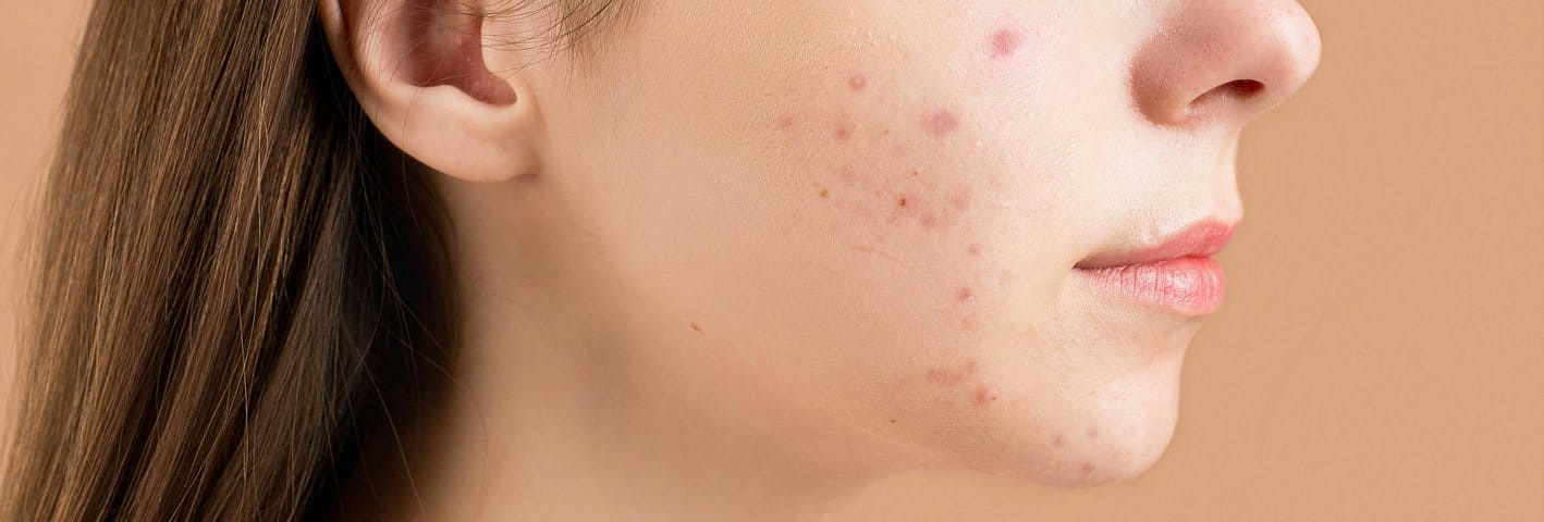 En la formación de los puntos negros, de las espinillas y de los granos intervienen muchos factores complejos