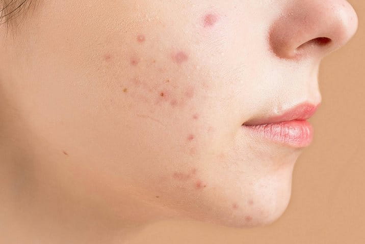 En la formación de los puntos negros, de las espinillas y de los granos intervienen muchos factores complejos