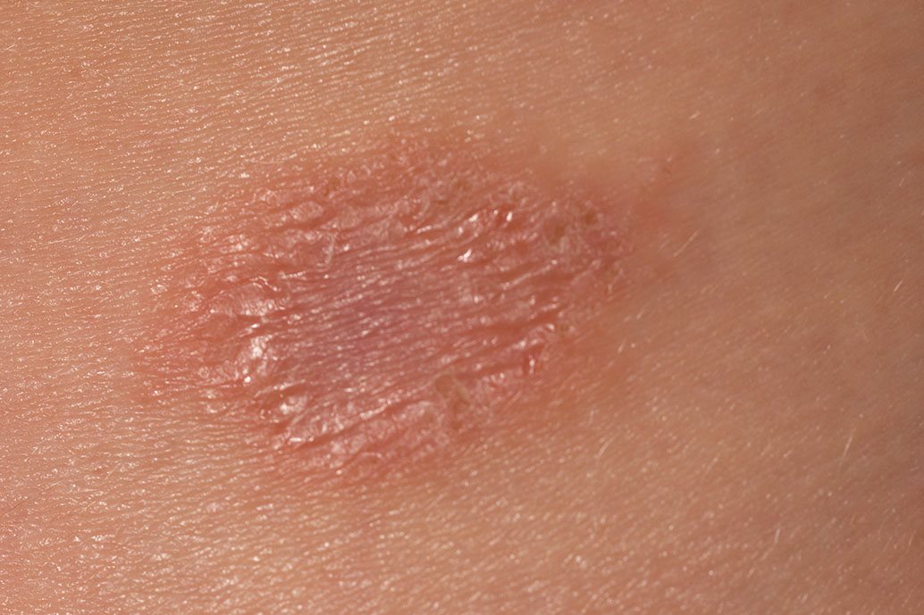 Eruzione cutanea di pitiriasi rosea di Gibert su torace, con chiazza madre e lesioni secondarie