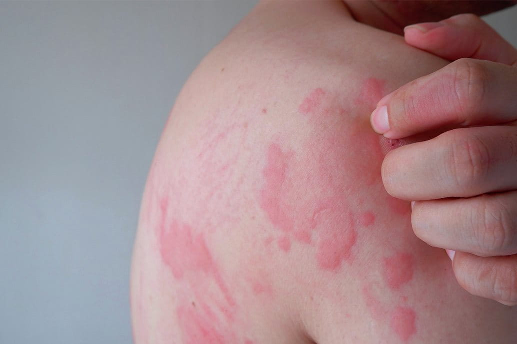 eritema cutaneo sul corpo