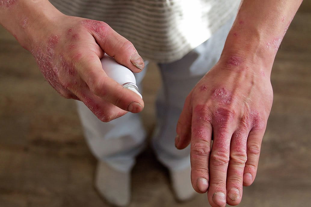 Applicazione di trattamento topico su mani affette da psoriasi pustolosa, con lesioni arrossate e desquamate visibili