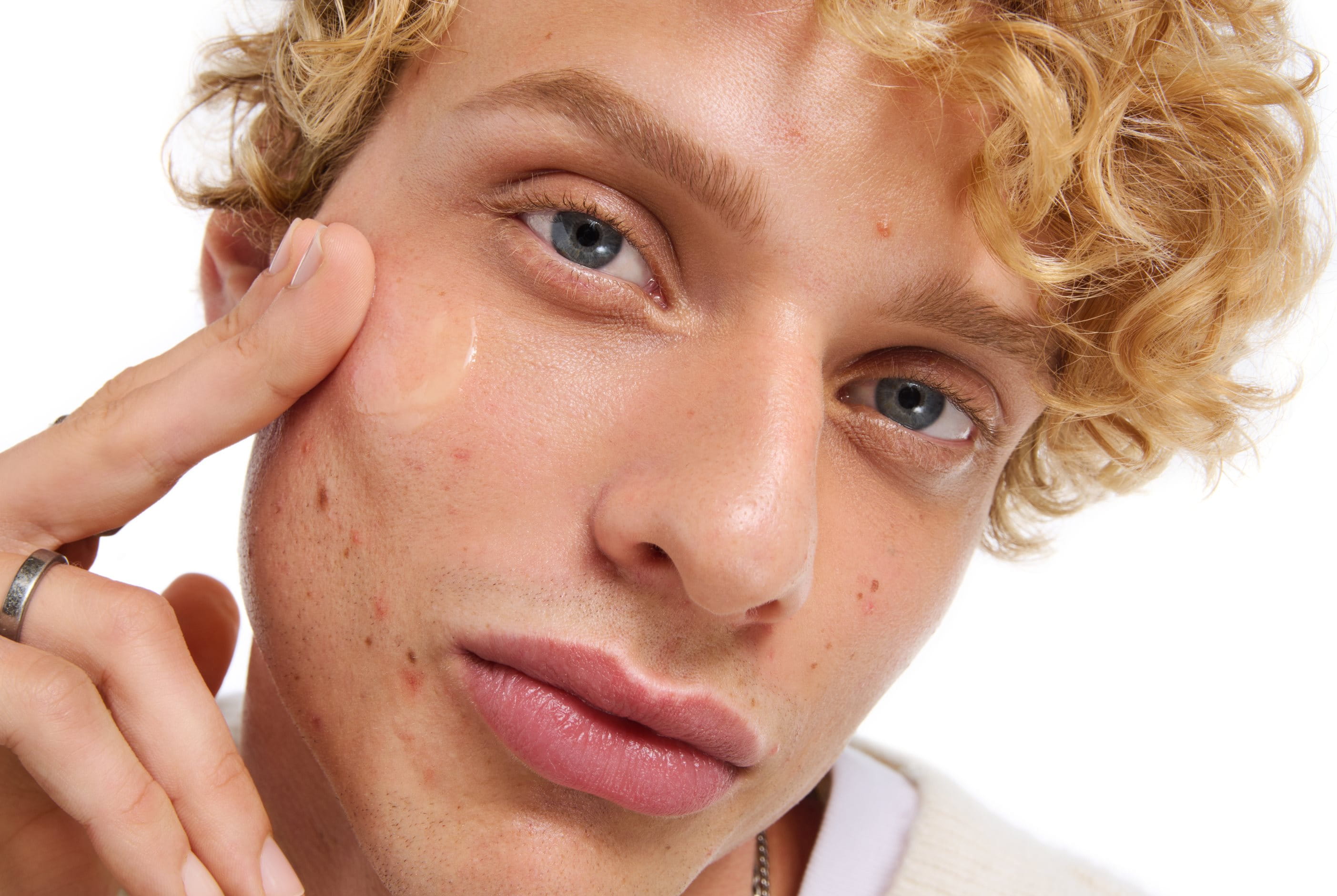 tratamientos-no-medicos-sin-medicacion-para-piel-con-impurezas-propensa-al-acne