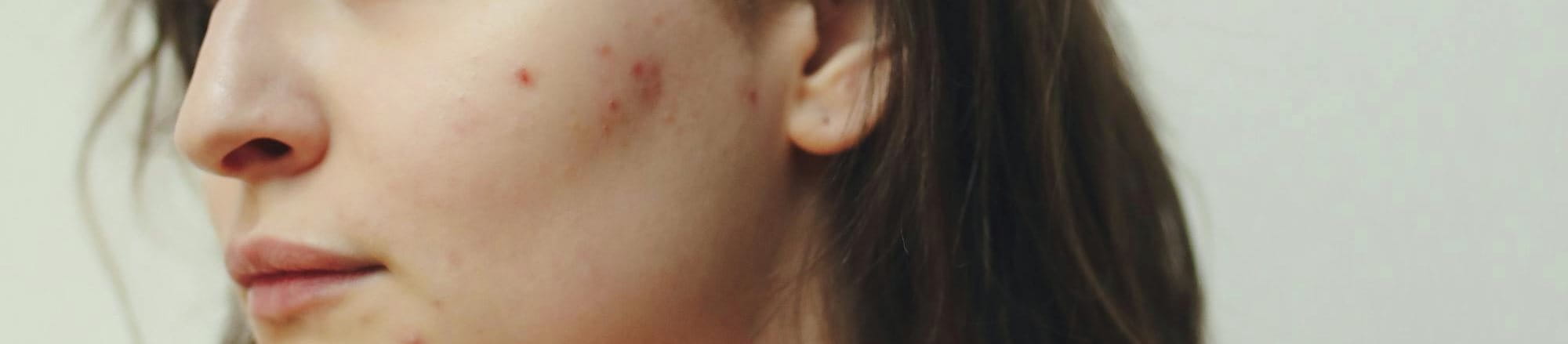 Detailaufnahme einer Frau mit entzündeten und teilweise geöffneten Pickeln an der Wange und am Kinn.