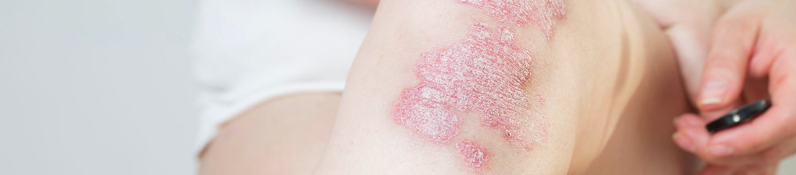 Primo piano di una gamba con psoriasi a placche con lesioni arrossate e squamose