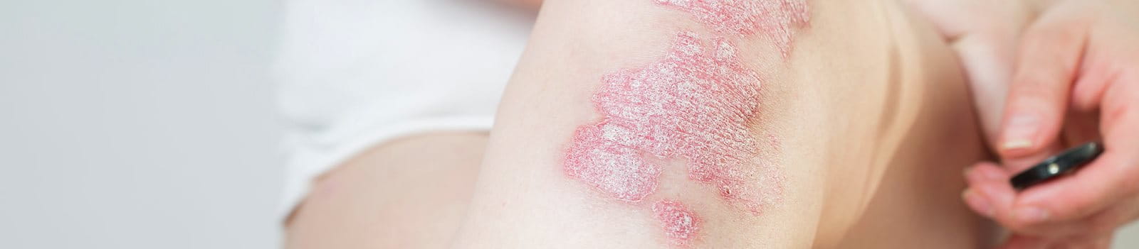 Primo piano di una gamba con psoriasi a placche con lesioni arrossate e squamose