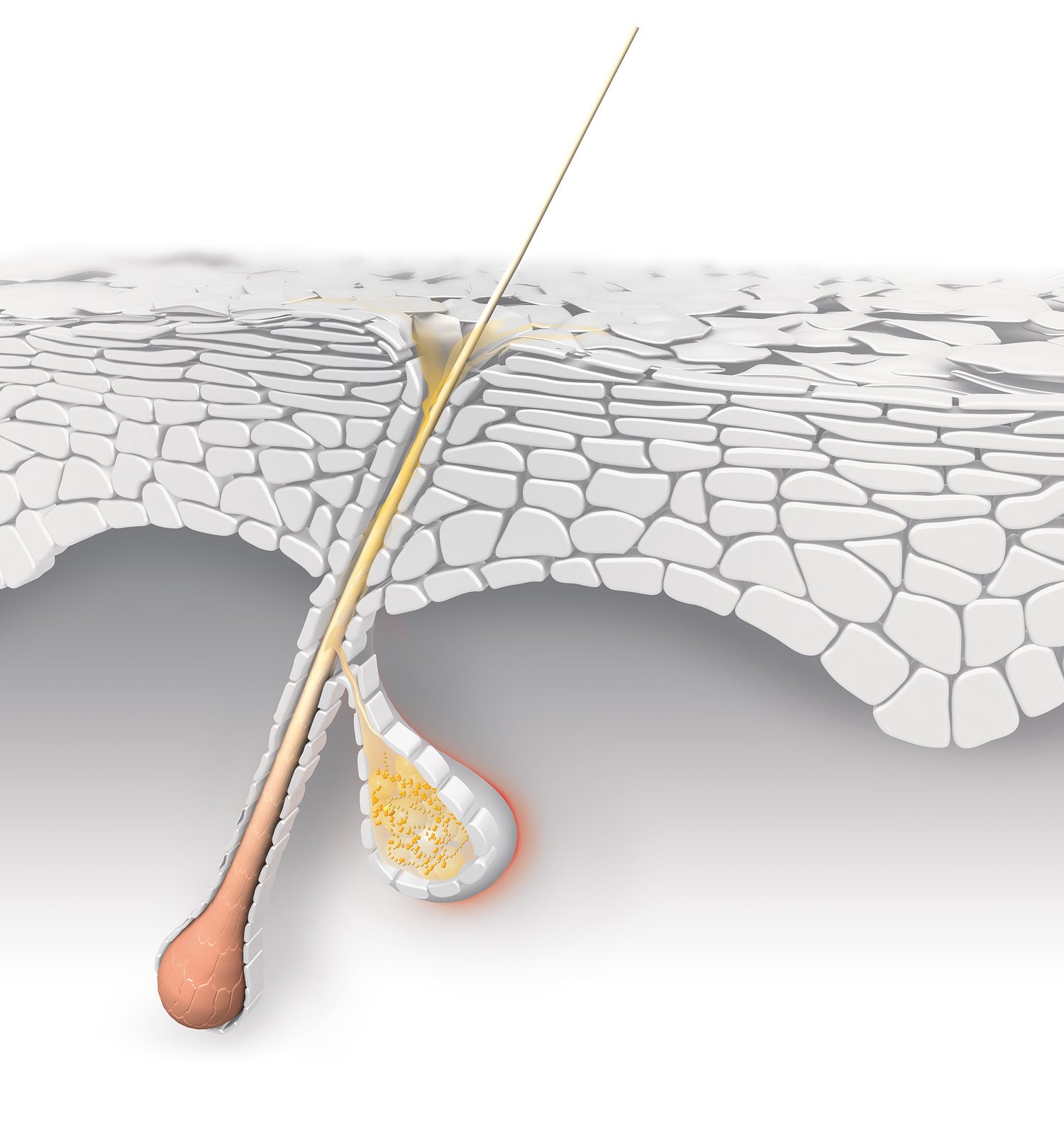 Grafische Darstellung der vermehrten Talgproduktion sowie entzündeter Haarfollikel und Talgdrüse.