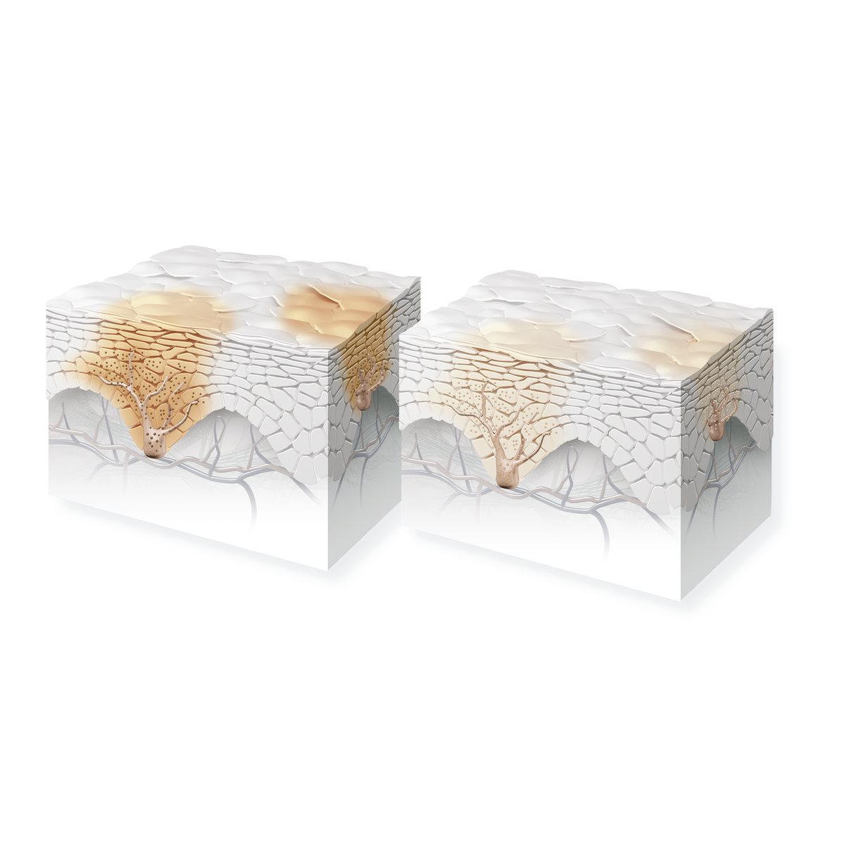 Schematische Darstellung der Epidermis mit einer Anhäufung von Melanozyten unten und dunklen Hautflecken oben.