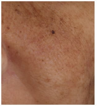skin discolouration on face