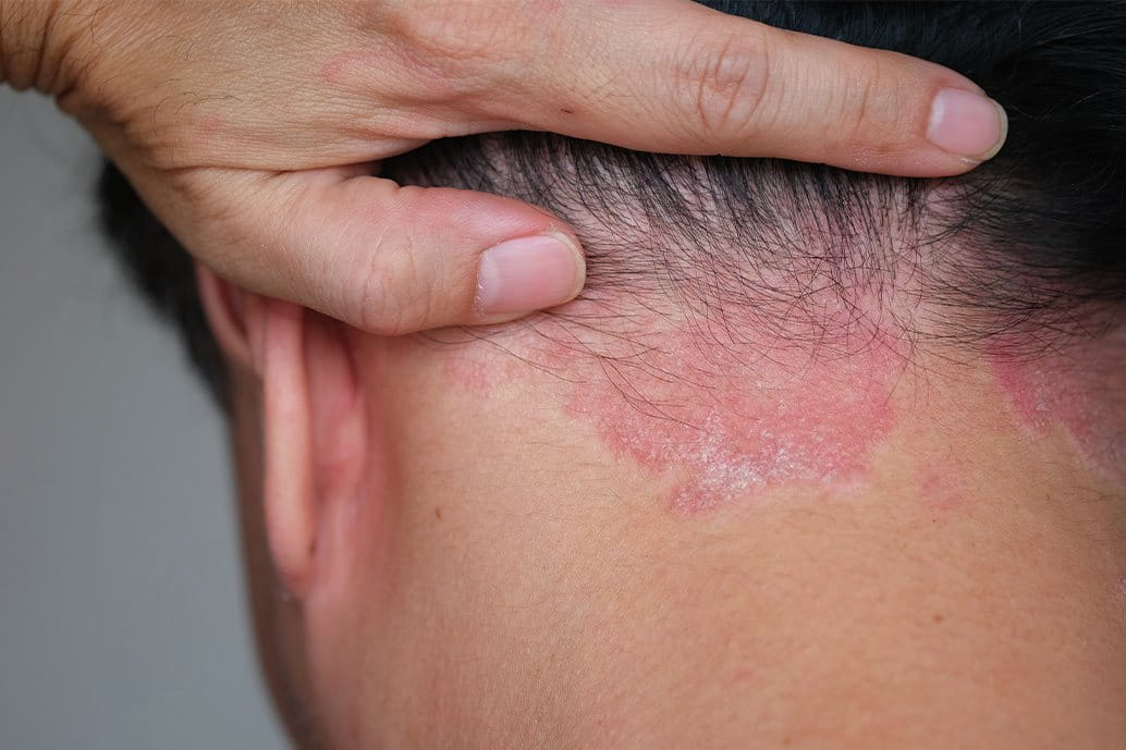 donna con dermatite seborroica