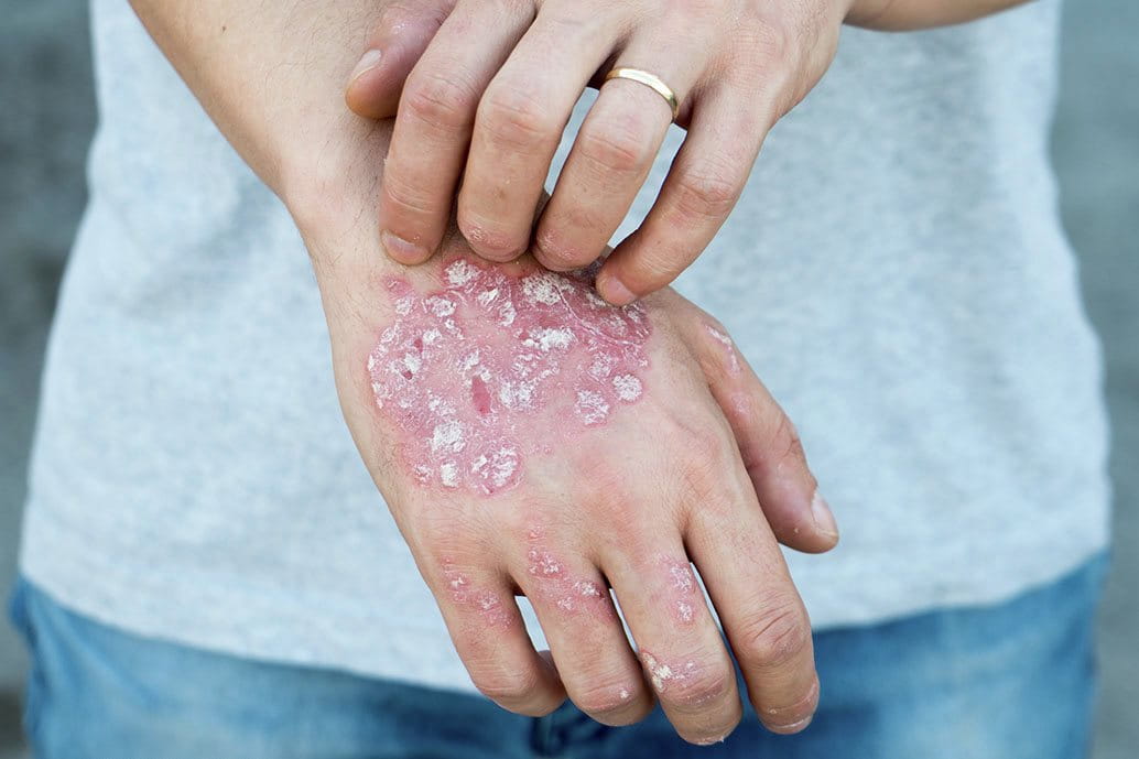 Psoriasi sul dorso della mano con placche arrossate e desquamazione della pelle