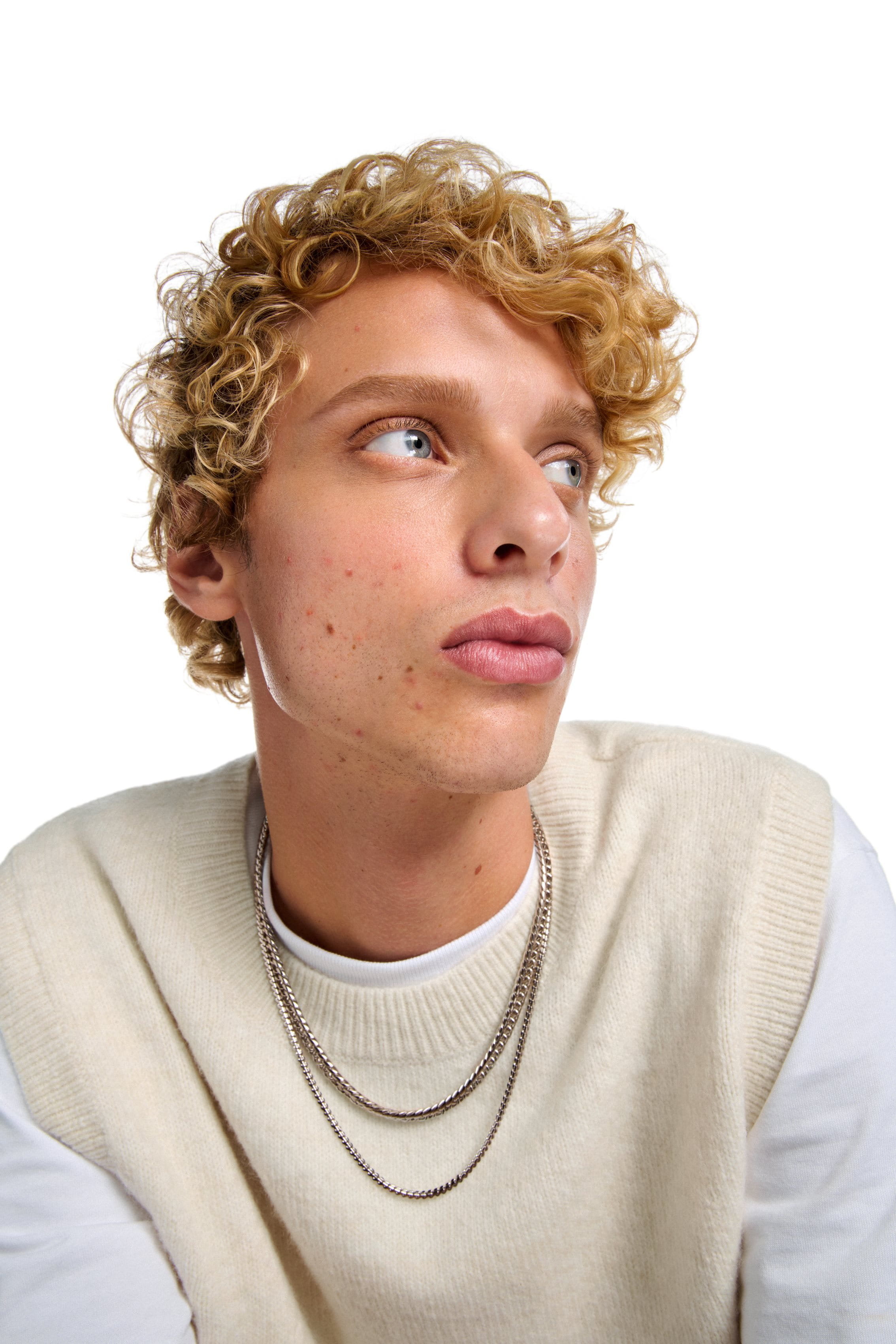 Close-up of blackheads and whiteheads on facial skin, illustrating typical stress-induced acne blemishes.
