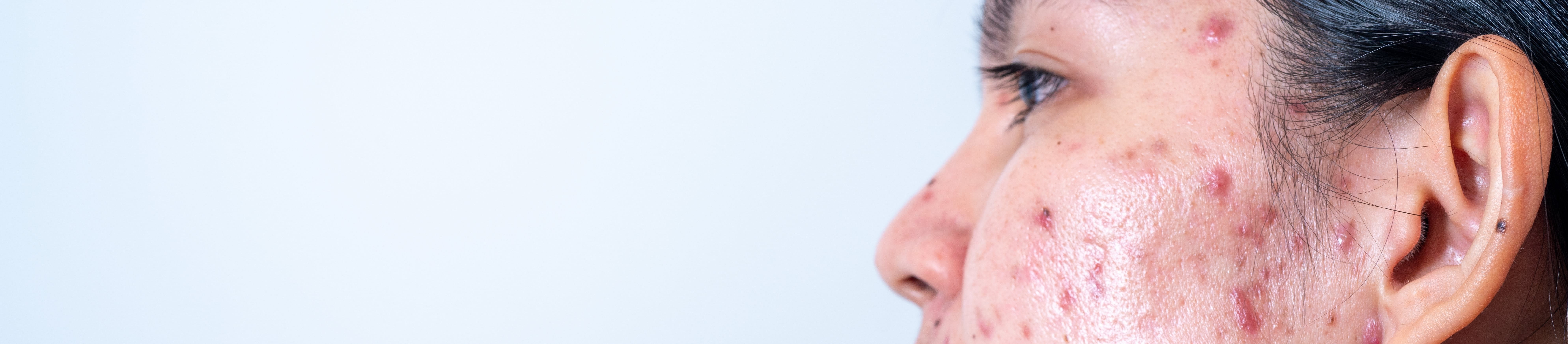 Eine Frau trägt mit einem Finger Creme auf ihr Gesicht auf, auf dem starke Akne zu sehen ist.