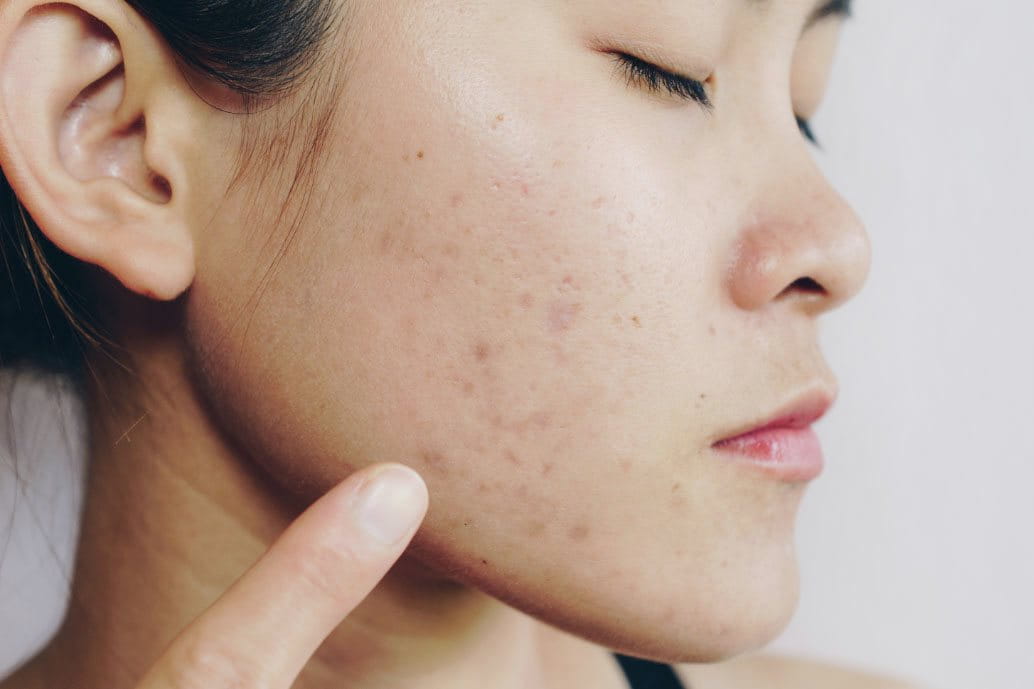 viso donna con pelle grassa o acneica