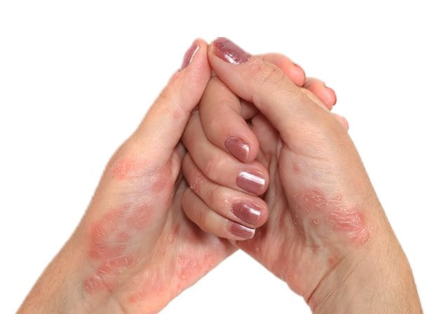  foto di ragazza con psoriasi mani 