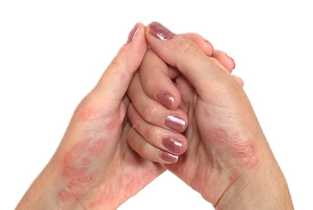 foto di ragazza con psoriasi mani