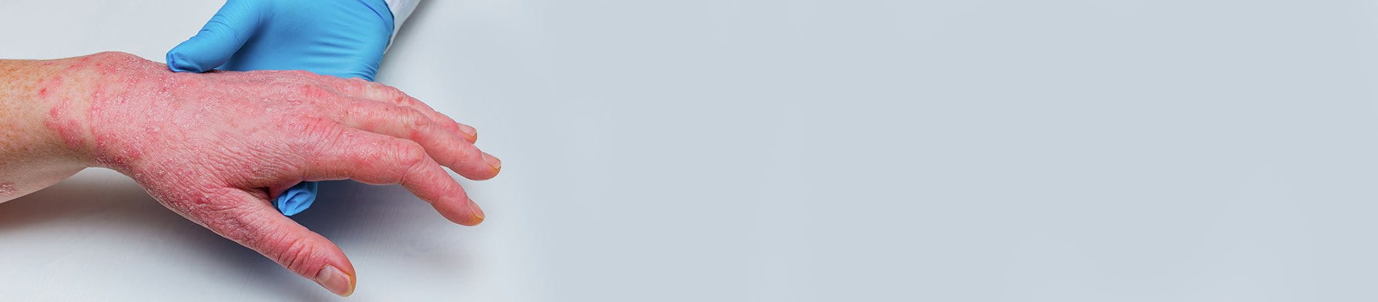 Mano con psoriasi eritrodermica in fase infiammata esaminata da un medico