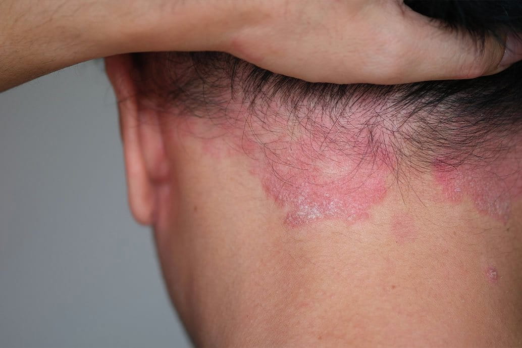 Psoriasi a placche localizzata sulla nuca e alla base del cuoio capelluto