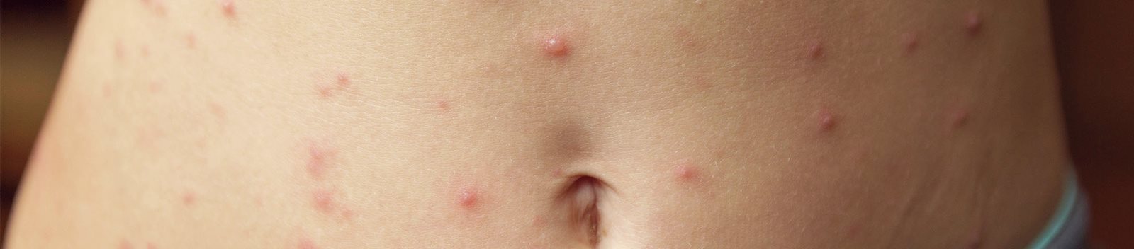 Parapsoriasi a piccole placche su addome e braccia di una donna, con chiazze eritematose sparse sulla pelle