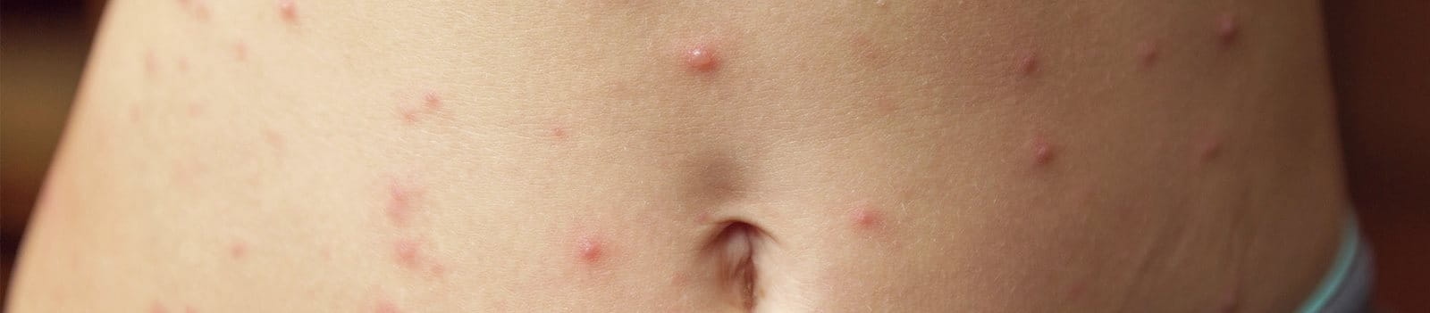 Parapsoriasi a piccole placche su addome e braccia di una donna, con chiazze eritematose sparse sulla pelle