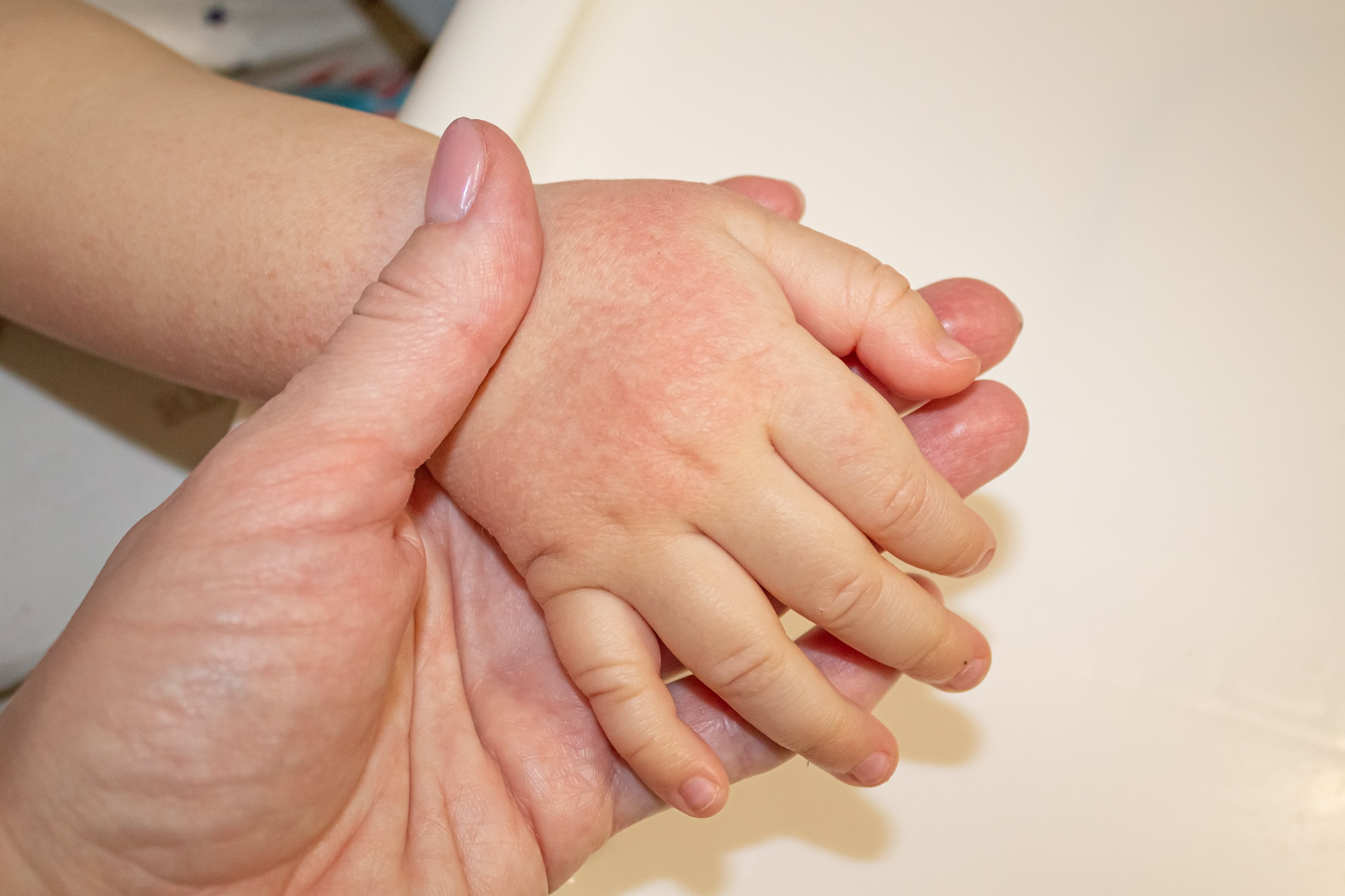Eine Babyhand, die gerötet ist, liegt in der Hand einer erwachsenen Person.