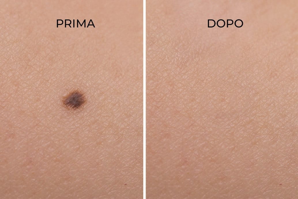 Cheratosi seborroica braccio prima e dopo la rimozione