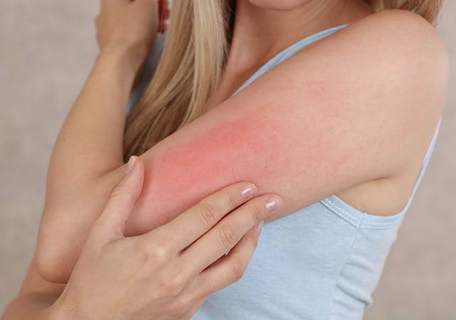 Orticaria solare sul braccio