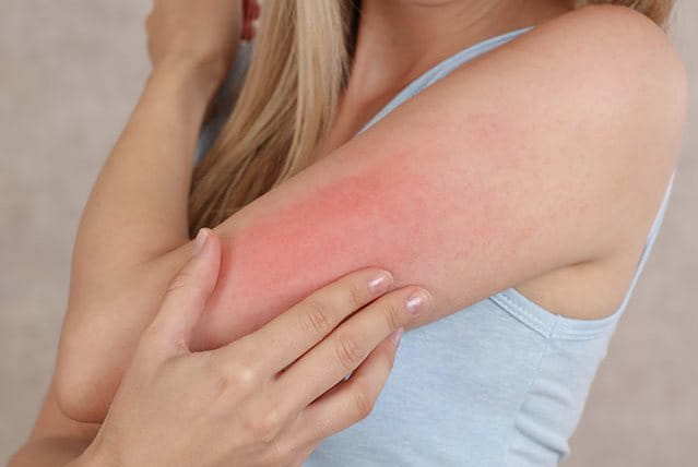 Orticaria solare sul braccio