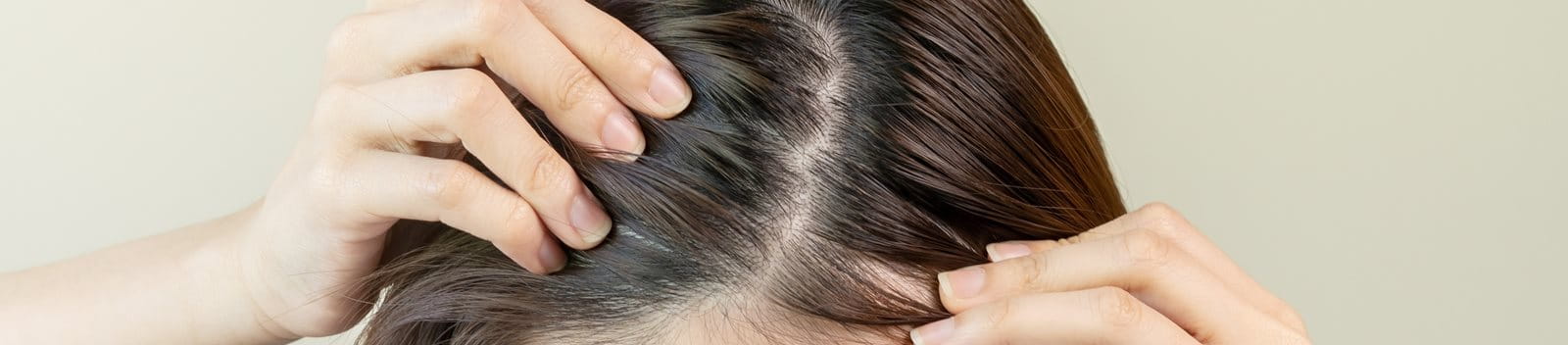 Wat zijn de oorzaken en oplossingen van psoriasis op de hoofdhuid?