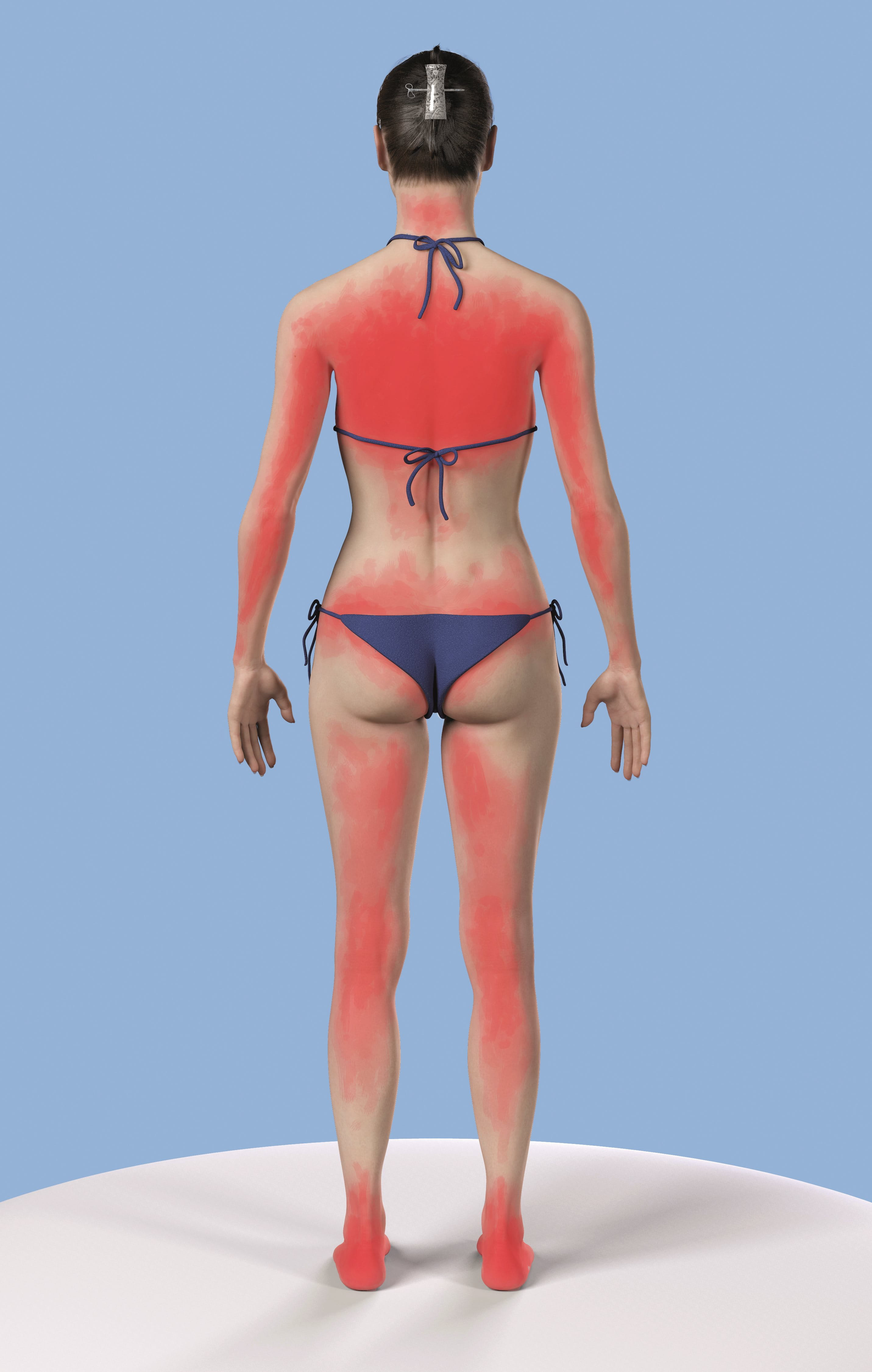 Ilustrație cu un adult – femeie, în costum de baie, văzută din față și din spate. Zonele roșii de pe piele indică arsuri solare cauzate de lipsa protecției solare adecvate. 