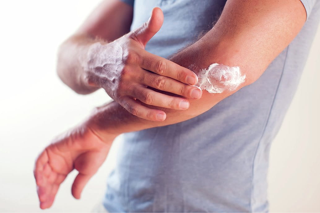 Uomo che applica un emolliente sulla pelle arrossata, affetta da parapsoriasi