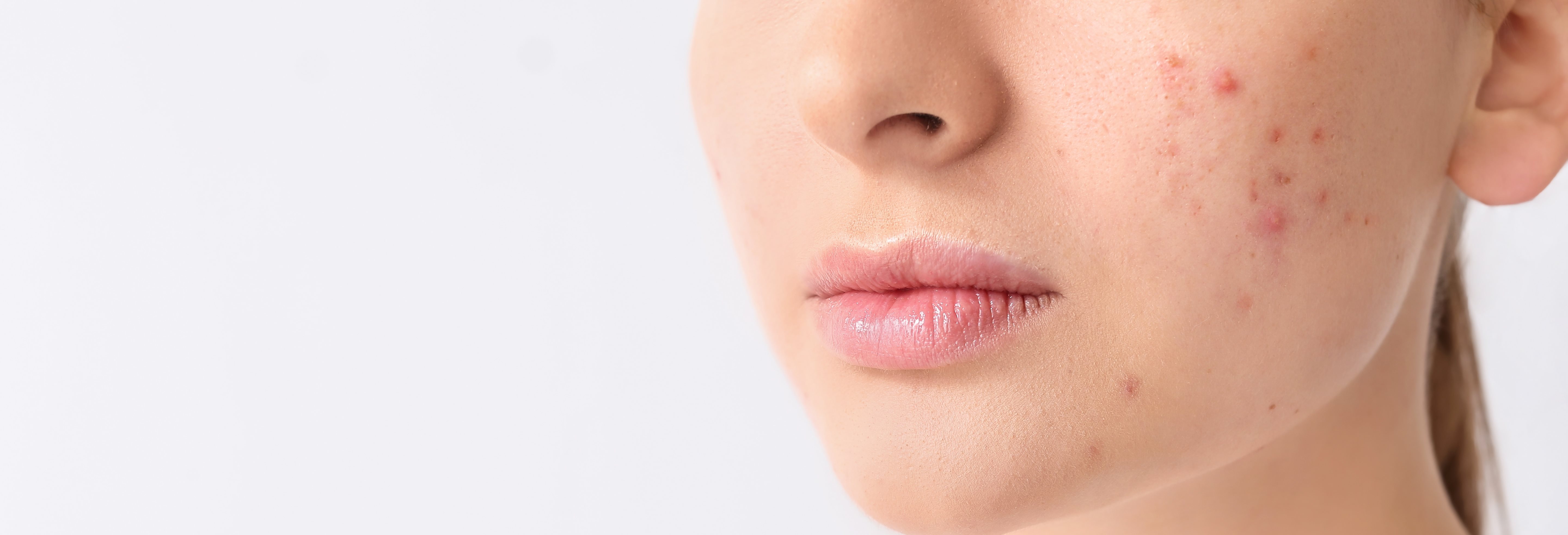 Nahaufnahme der Wange einer Frau mit Akne und Eiterpickeln