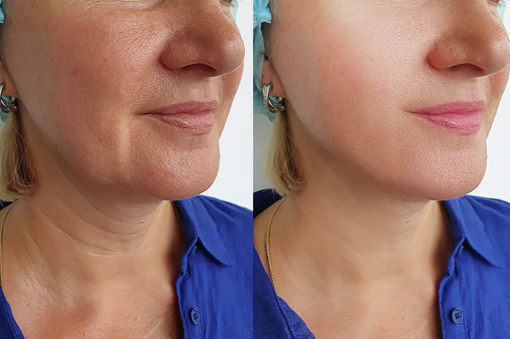 Prima e dopo un trattamento di biostimolazione del viso: a sinistra, pelle con texture irregolare; a destra, pelle più uniforme dopo il trattamento