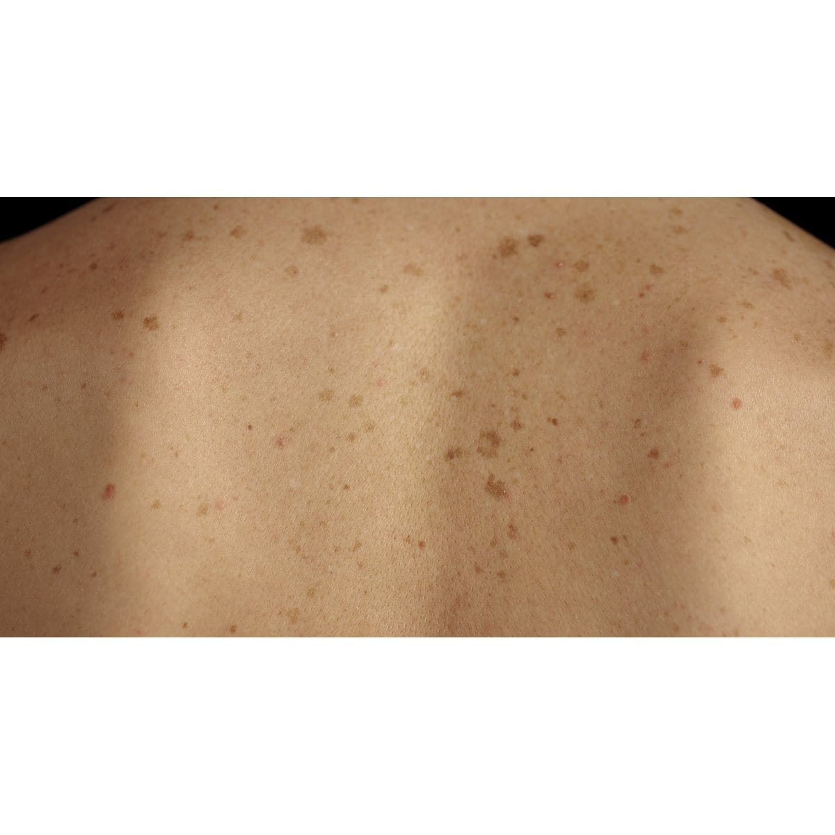 Rücken einer Person mit zahlreichen Pigmentflecken und Sommersprossen auf der Haut.