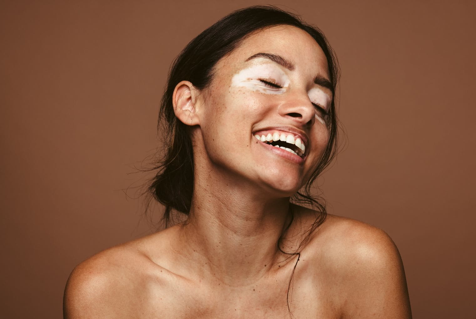 Hypopigmentatie treedt op wanneer de huid minder melanine produceert dan normaal.