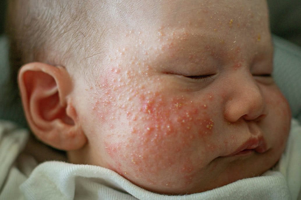 Viso di un neonato con acne neonatale.