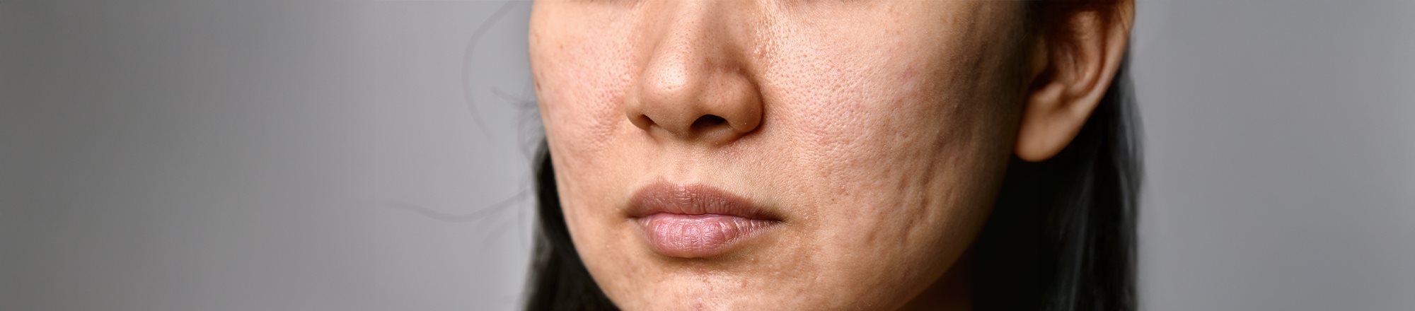 Frau mit Akne im Gesicht