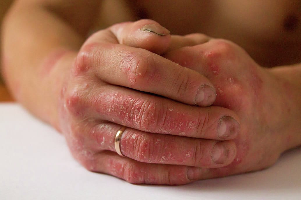 Mani di una donna affetta da psoriasi eritrodermica, con pelle arrossata e desquamata
