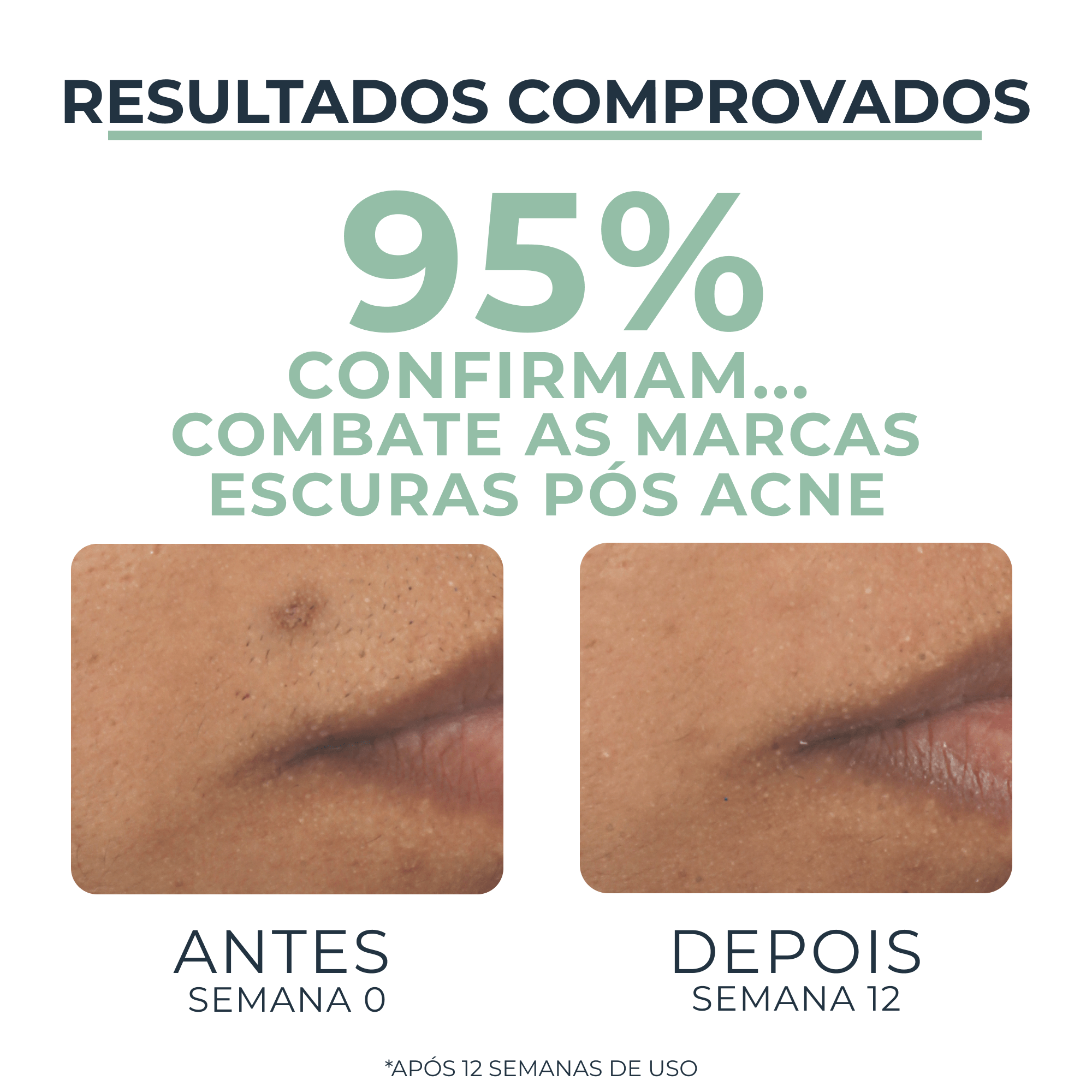 Como tratar marcas de acne? Use a linha Eucerin DermoPure