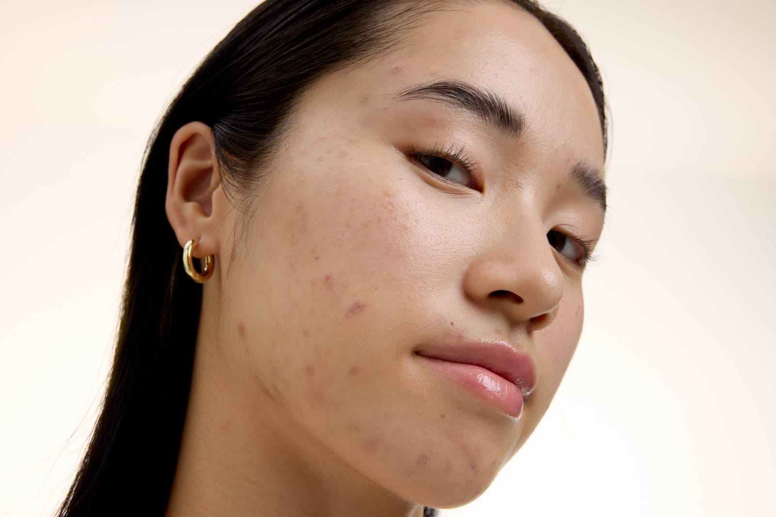 Post-acne vlekken kunnen meerdere jaren zichtbaar blijven, en de tekenen worden verergerd door de zon.