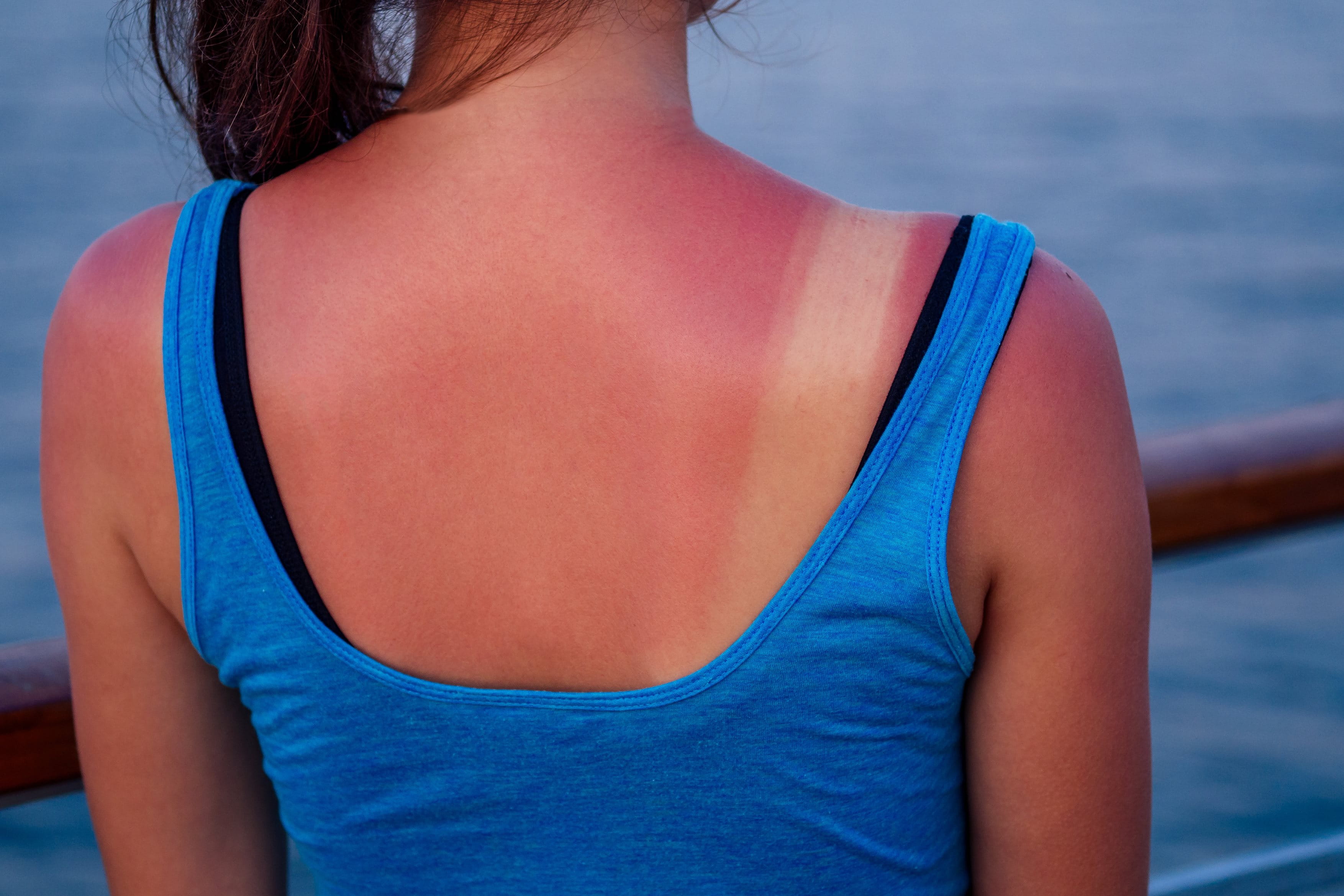 Eine Aufnahme einer Frau von hinten, die unter Sonnenbrand leidet.