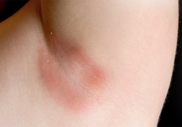 foto donna con intertrigine ascellare