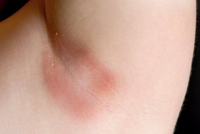 foto donna con intertrigine ascellare