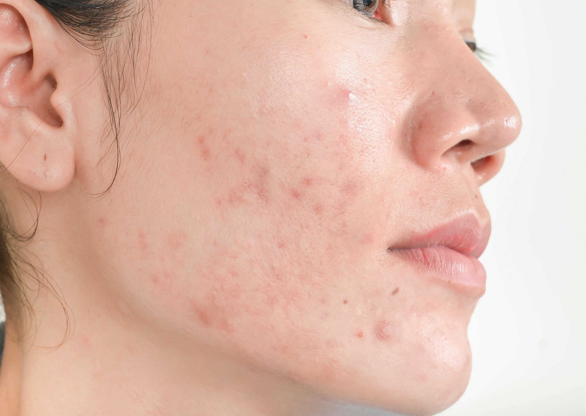 A woman with close-up look, with blemishes and purging skin