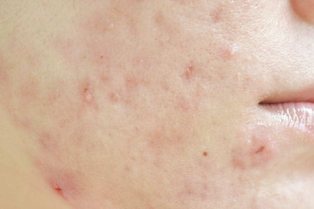 Primo piano viso di donna con segni di acne e impurità della pelle